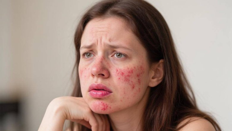 Синдром Стивенса-Джонсона: Что за аллергия на лекарства вызвала у россиянки кровь из губ